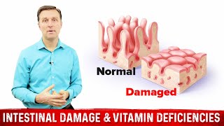 Intestinal Obstruction amp Vitamin Deficiencies – Dr Berg [upl. by Dronel]