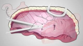 Skills Laboratory How to perform a beltloop gastropexy [upl. by Nuaj]